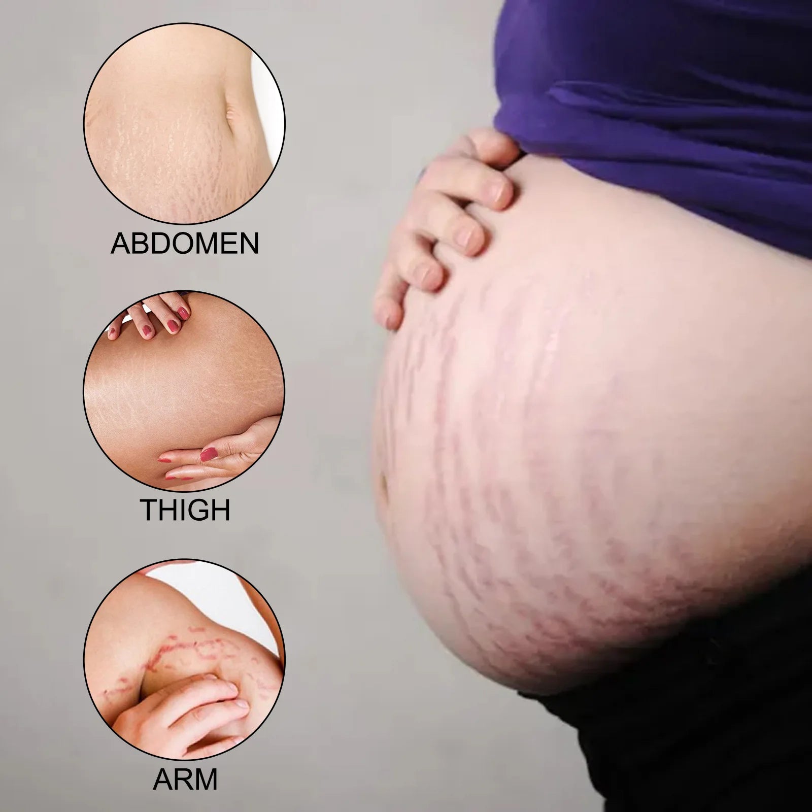 Ouhoe 100g Stretch Mark Removal Cream Maternity